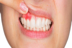 بیماری لثه