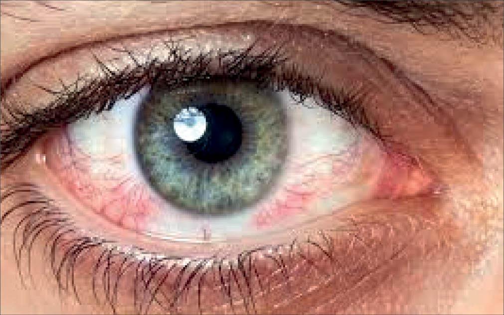 دلایل قرمزشدن سفیدی چشم