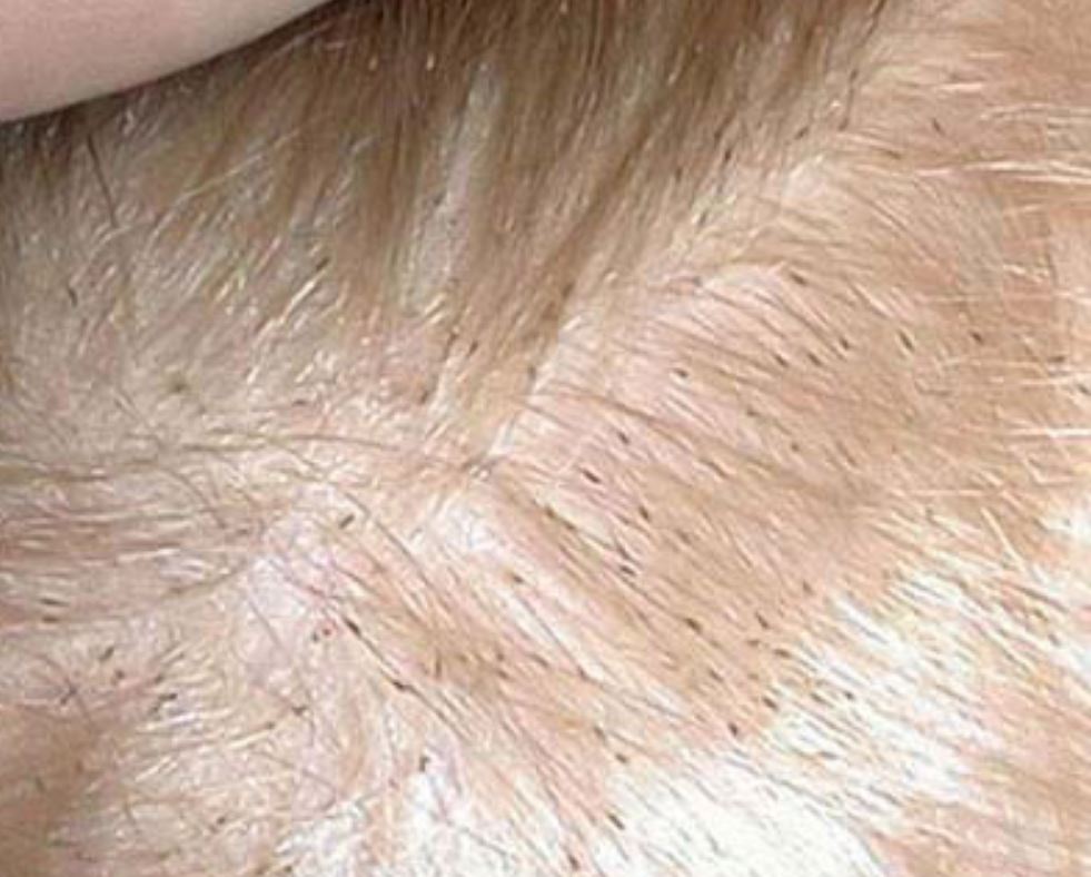 تعبیر خواب شپش تعبیر خواب شپش