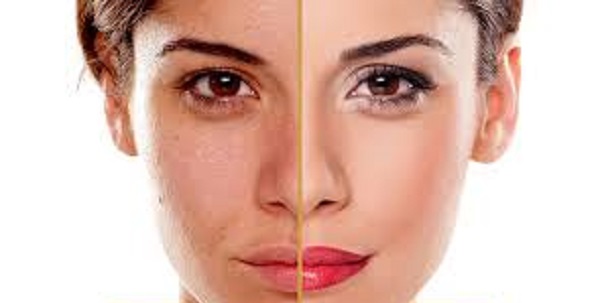 مزیت لایه برداری شیمیایی