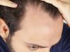 ریزش مو و طاسی