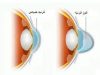 قوز قرنیه