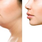 رژیم لاغری غبغب