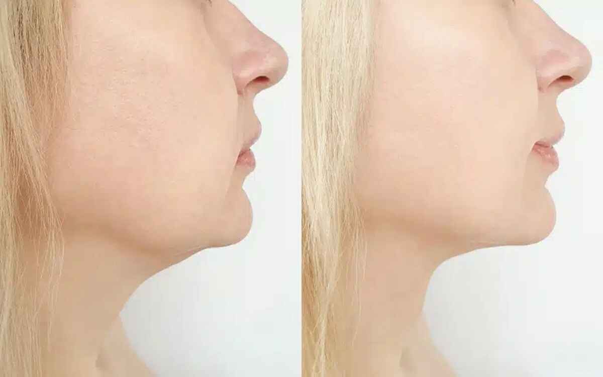 رژیم لاغری غبغب