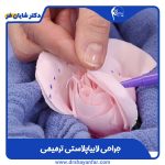 وقتی نتیجه لابیاپلاستی رضایت‌ بخش نیست ؛ جراحی ترمیمی چه کمکی می‌ کند؟