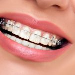 مدت زمان ارتودنسی و 5 عامل اصلی موثر بر آن