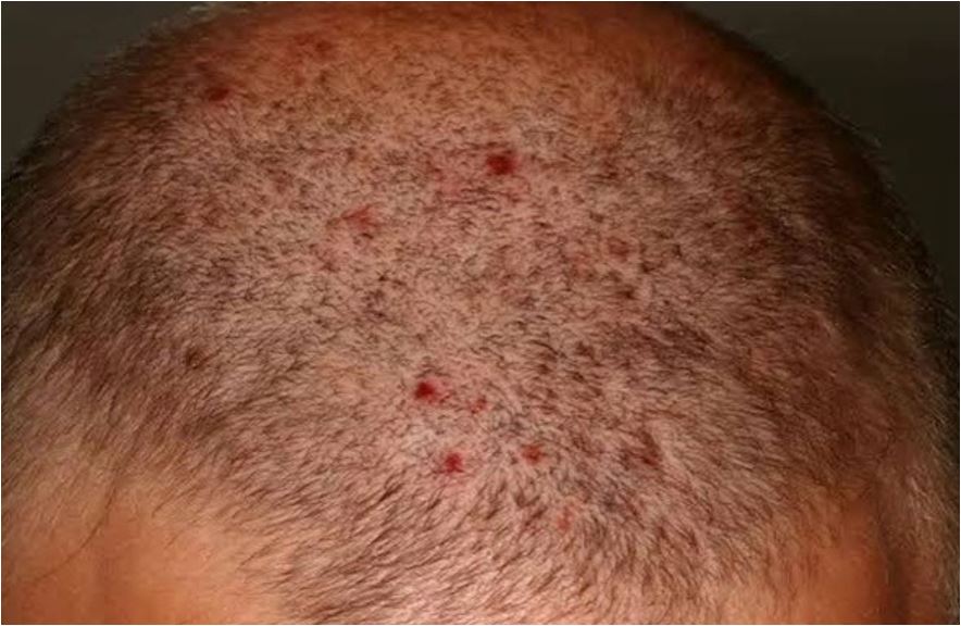 جوش سر نشانه چیست؟ ۹ علت، از شامپو تا هورمون 4 جوش سر نشانه چیست؟ ۹ علت، از شامپو تا هورمون