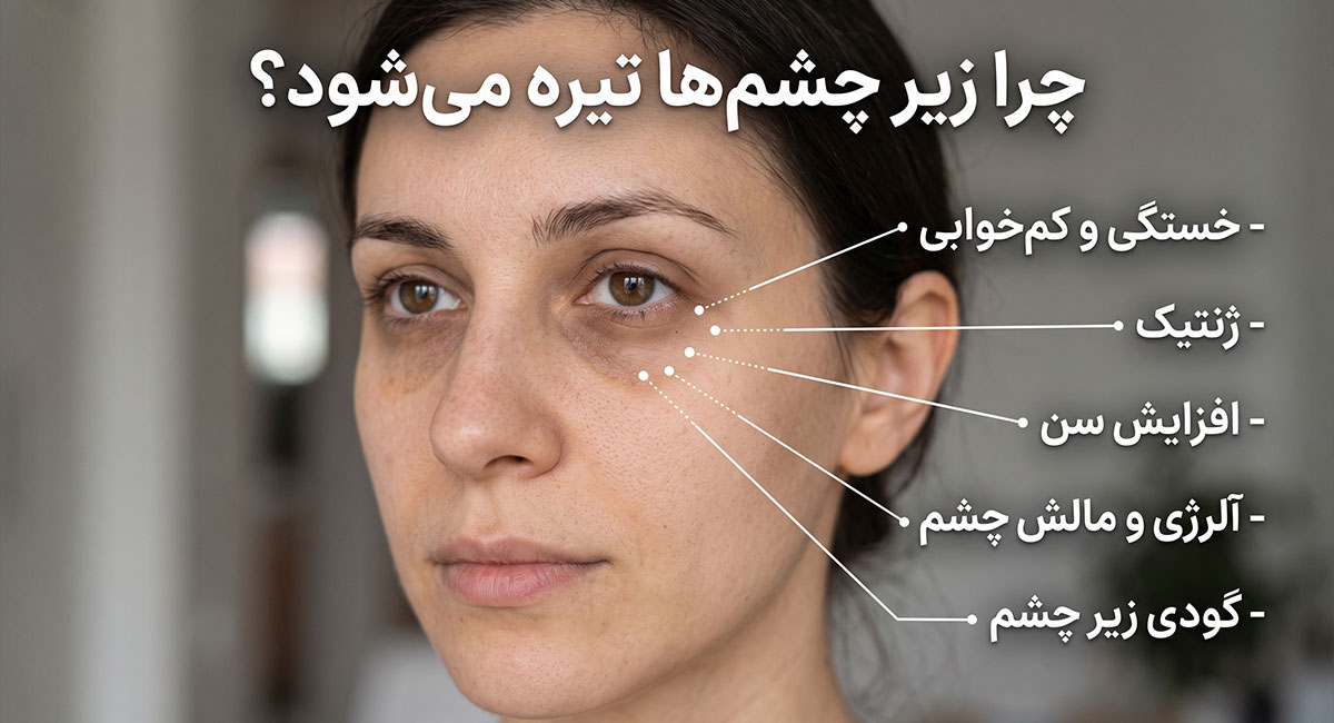 چرا زیر چشم های ما تیره می شود؟ کشف ریشه مشکل